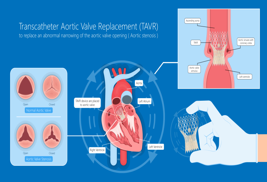 effective-treatment-options-for-aortic-stenosis-in-india-add-more-to