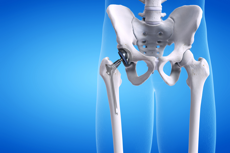 hip-replacement-recovery-tips-from-doctors-and-patients