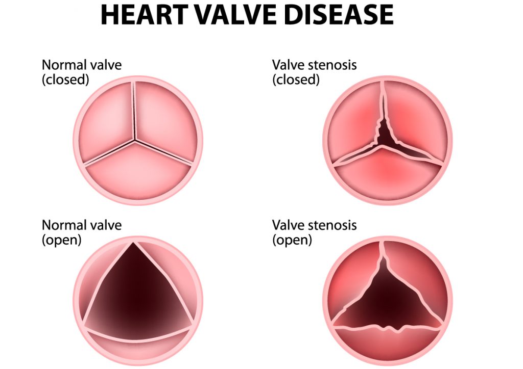 Understanding Aortic Stenosis Symptoms And Treatments Add More To