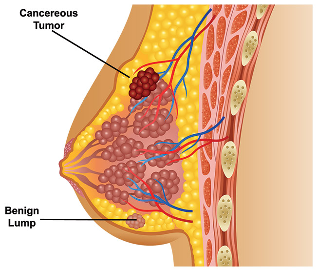 Understanding the Different Types of Breast Cancer