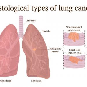 Lung cancer: Types and risk factors | Add More to Life - Meril