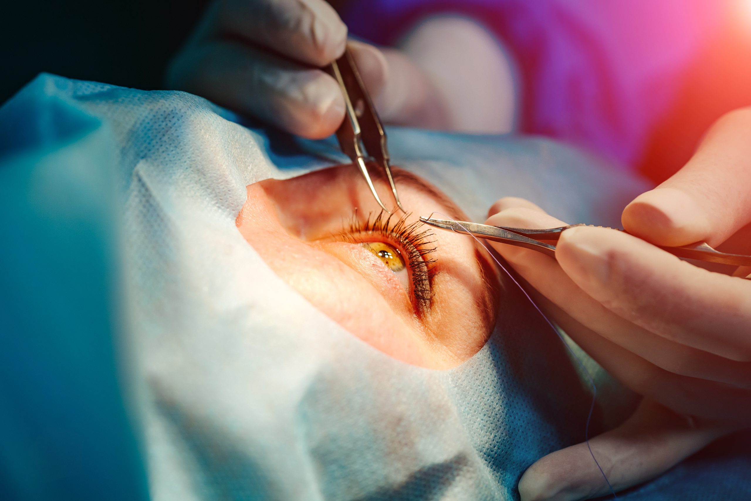 What Makes Suture Relevant In Ophthalmic Surgery In The Age Of Lasers 