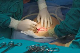 C-section surgery – Add more to Life