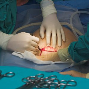 Behind the Decision: Factors Determining Cesarean Section Requirements for Women