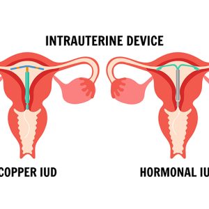 Life with an Intrauterine Device: Dispelling Myths and Addressing Concerns
