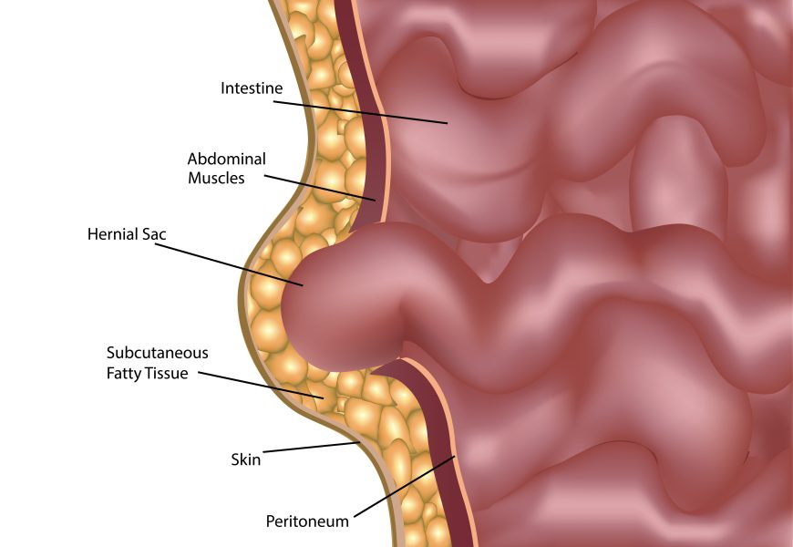 Common Myths About Hernias Addressed