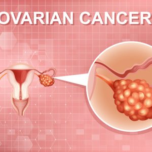 Prioritizing Ovarian Cancer Screening for Every Woman